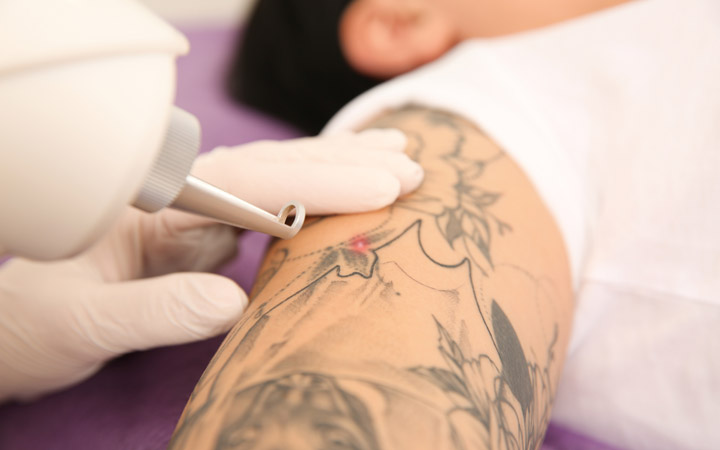 Breaking Down the Process: How Laser Tattoo Removal Works - Wellsprings  Medical and Spa